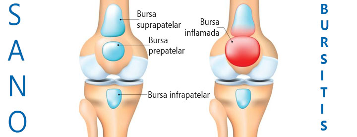 Qué es la Bursitis