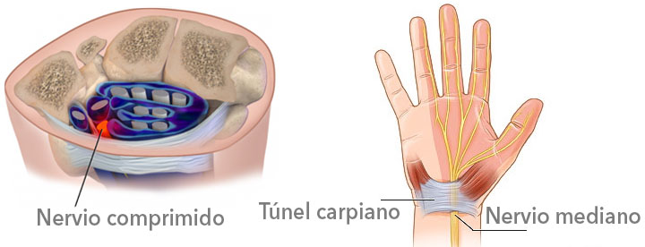 Qué es el sindrome del túnel carpiano