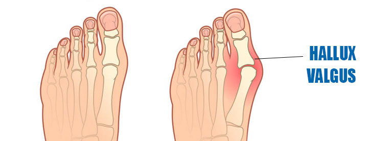 Férulas nocturnas para Hallux Valgus