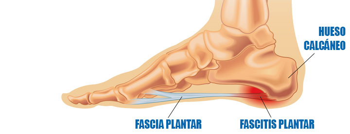 Férulas Nocturnas para Fascitis Plantar