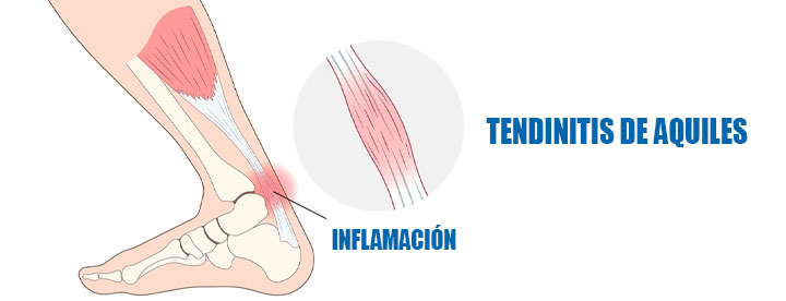 Férulas Nocturnas para Tendinitis de Aquiles